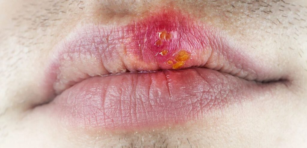 Lippenherpes mit krustiger Oberfläche